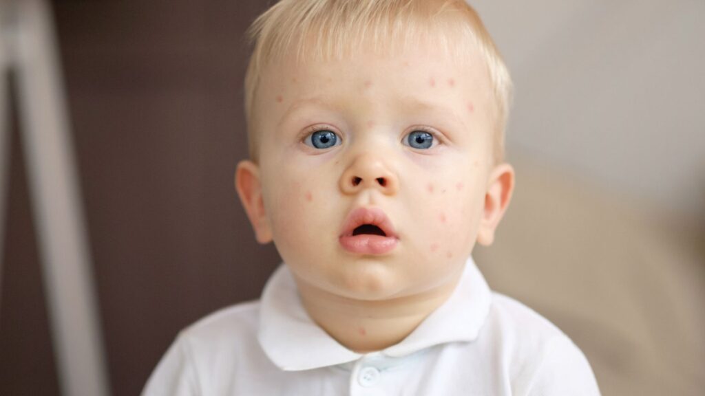 Chicken Pox Vaccination in Ealing